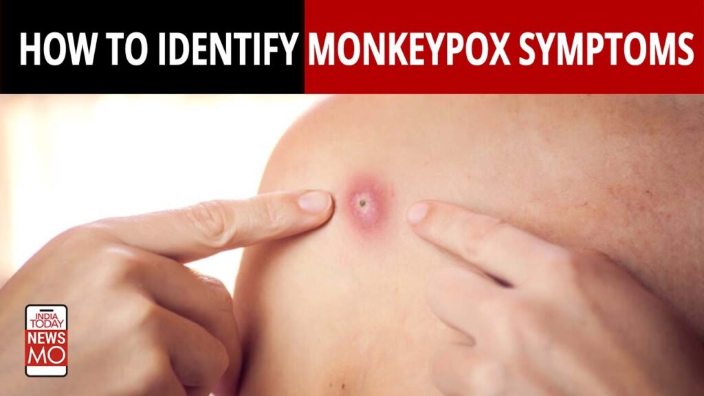 Monkeypox